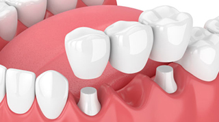 Dental bridges -  Dentistry: Reconstructive and Cosmetic Dentists in the heart of Miami