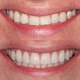 Ceramic Veneers -  Dentistry: Reconstructive and Cosmetic Dentists in the heart of Miami