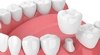 Dental Crown and caps -  Dentistry: Reconstructive and Cosmetic Dentists in the heart of Miami