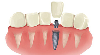 Dental Crown and caps in Miami