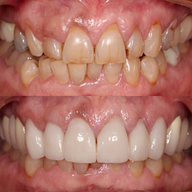 Ceramic Crowns -  Dentistry: Reconstructive and Cosmetic Dentists in the heart of Miami