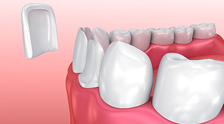 Veneers -  Dentistry: Reconstructive and Cosmetic Dentists in the heart of Miami