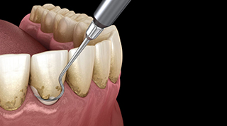 Scaling and root planing - Brickell Dentistry - Reconstructive and Cosmetic Dentists in the heart of Miami